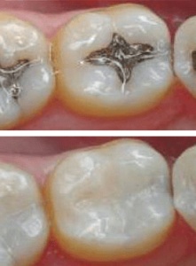 Amalgam fillings vs sale composite