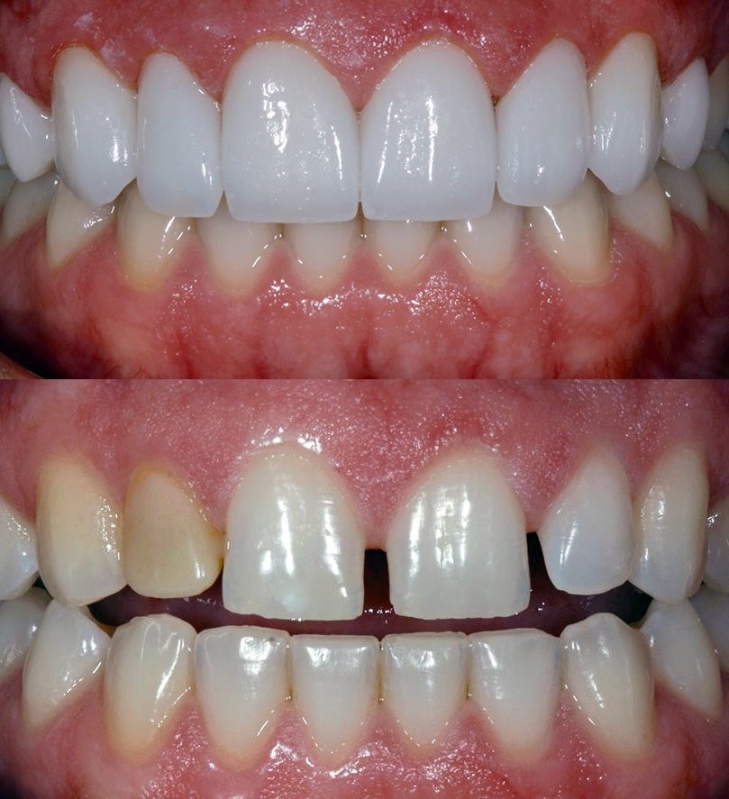 veneers vs crowns