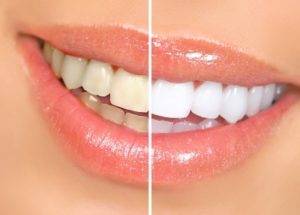 Advanced In-Office Whitening : Dental Office Prescott AZ