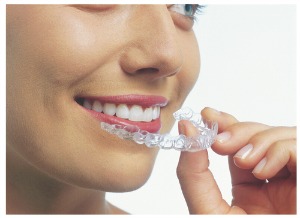 Guidelines for When Invisalign Clear Aligner Trays Are in Your Mouth -  Sonoran Desert Dentistry Scottsdale Arizona