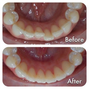 What is Invisalign Treatment?