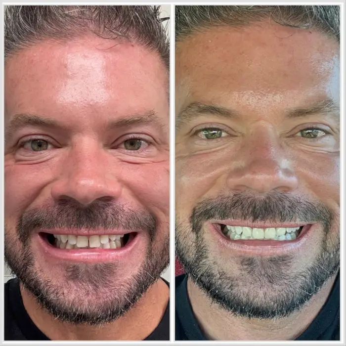 patient smiles before and after Veneers Prescott AZ