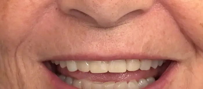 Close-up of a patient's natural-looking smile after cosmetic dental treatment at Prescott Dental Arts in Prescott, AZ